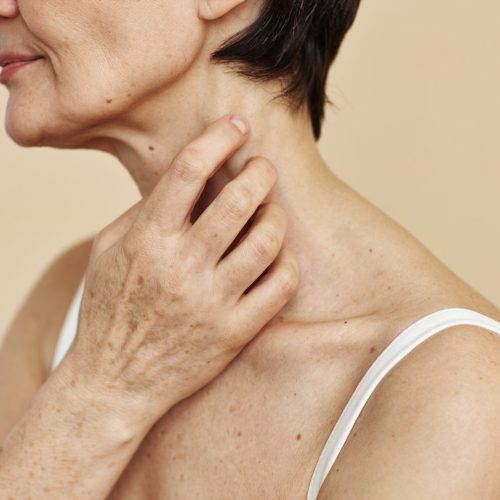 Close up of senior woman scratching neck with psoriasis spot suffering from skin condition, copy space